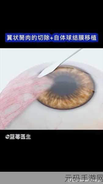 绑定超级胬肉系统:1. 超级胬肉系统:全面提升眼部健康的新契机